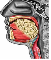 Tongue Cancer